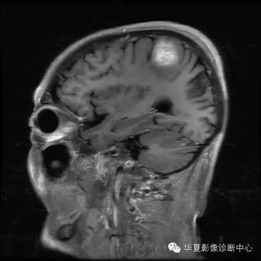 【病例】这个脑转移瘤你会误诊吗？