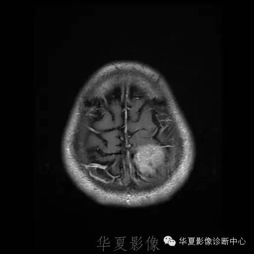 【病例】这个脑转移瘤你会误诊吗？