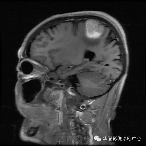 【病例】这个脑转移瘤你会误诊吗？