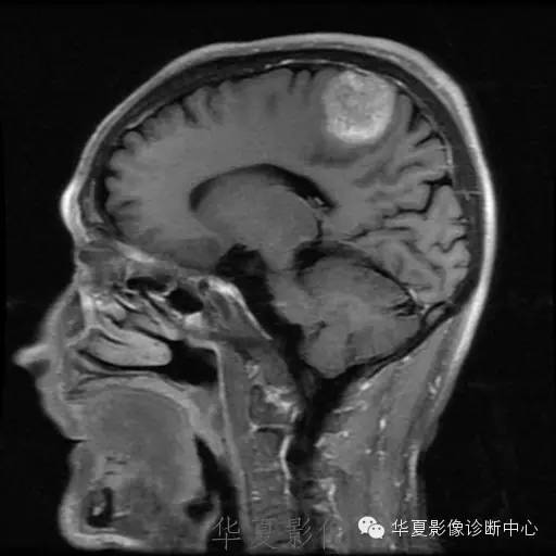 【病例】这个脑转移瘤你会误诊吗？