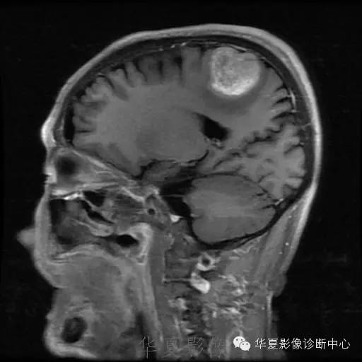 【病例】这个脑转移瘤你会误诊吗？