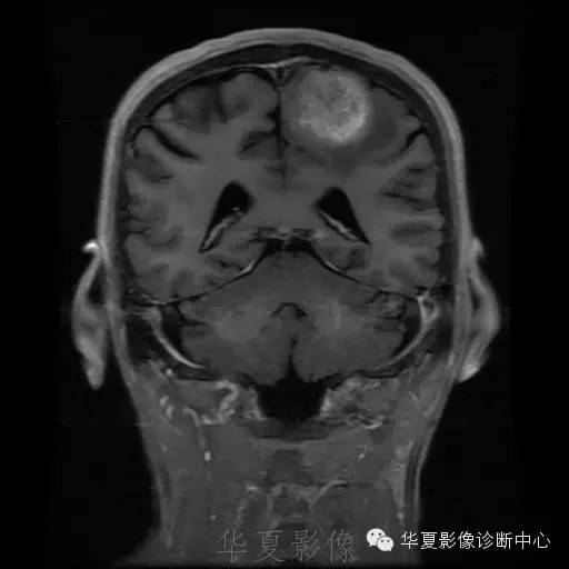 【病例】这个脑转移瘤你会误诊吗？