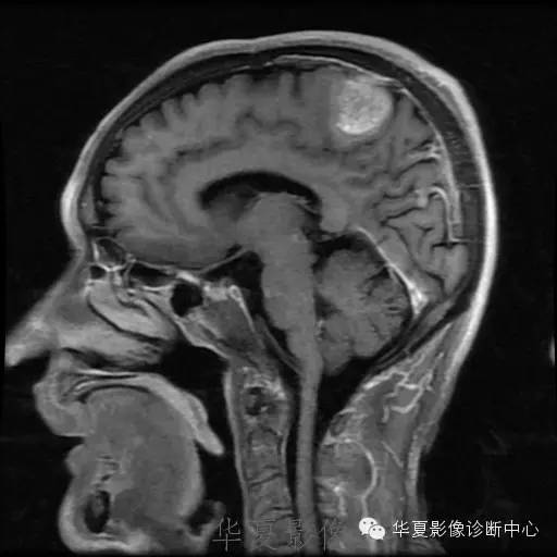 【病例】这个脑转移瘤你会误诊吗？