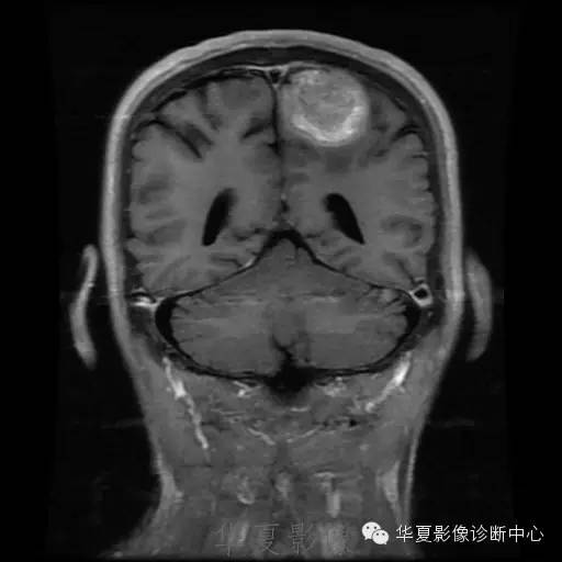 【病例】这个脑转移瘤你会误诊吗？