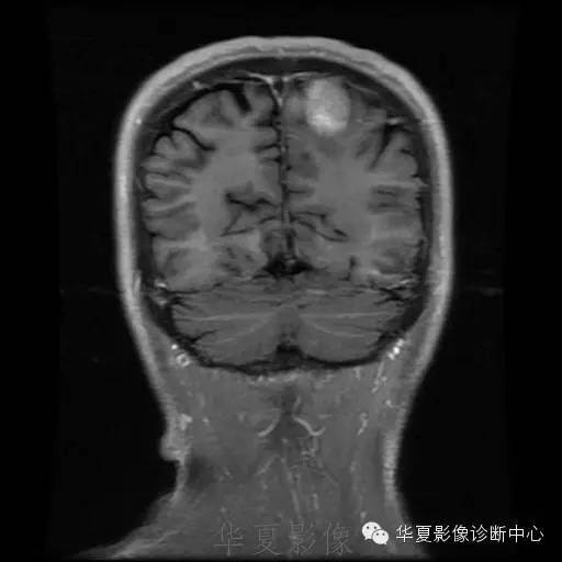 【病例】这个脑转移瘤你会误诊吗？