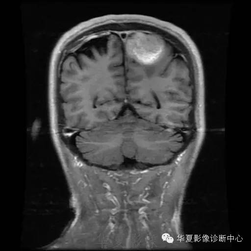 【病例】这个脑转移瘤你会误诊吗？