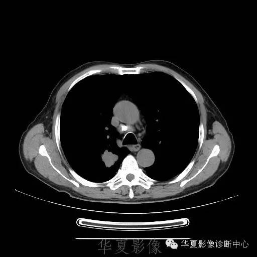 【病例】这个脑转移瘤你会误诊吗？