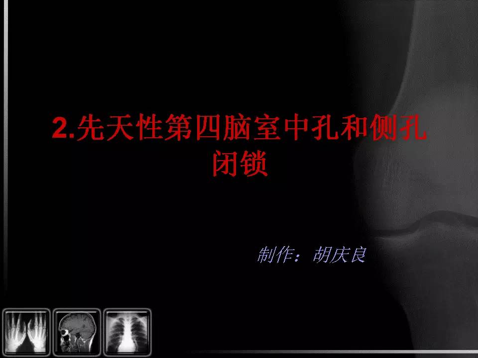 【PPT】先天性第四脑室中孔和侧孔闭锁