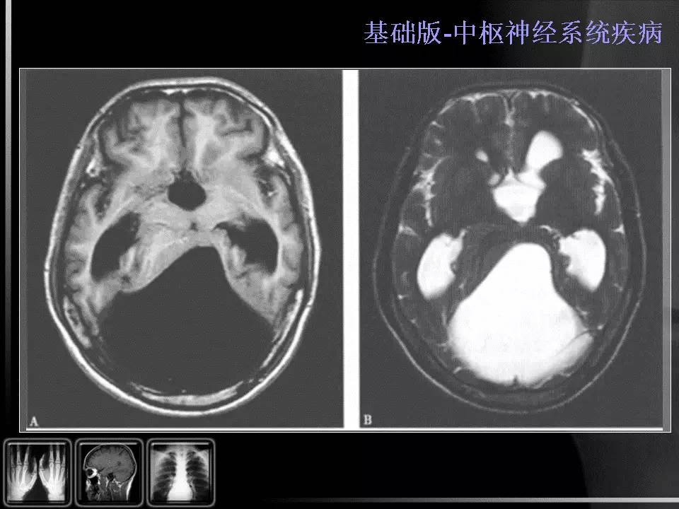 【PPT】先天性第四脑室中孔和侧孔闭锁