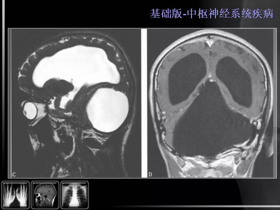 【PPT】先天性第四脑室中孔和侧孔闭锁