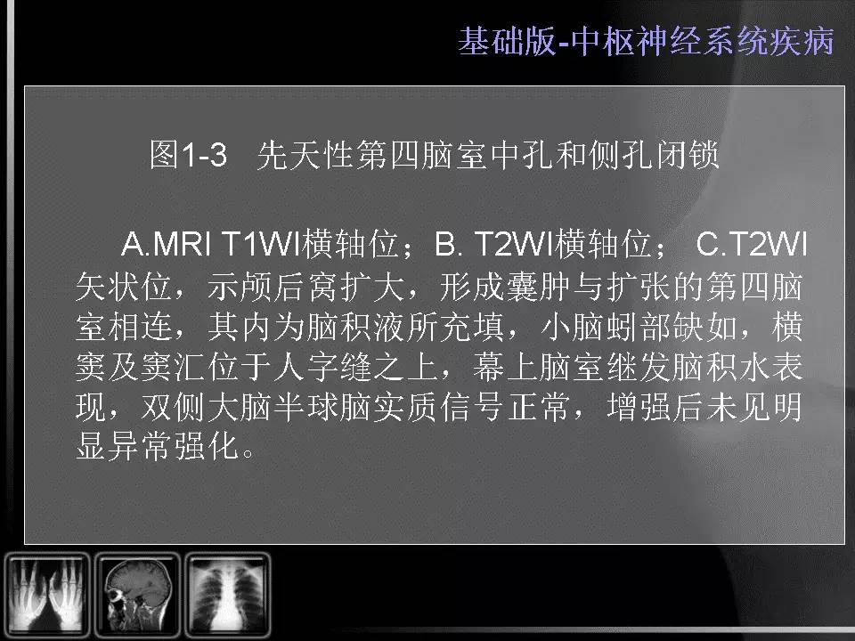 【PPT】先天性第四脑室中孔和侧孔闭锁