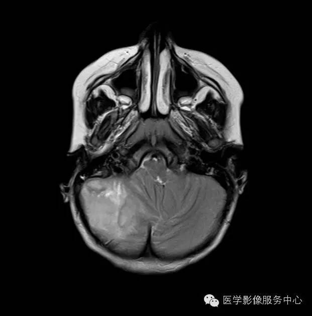 【病例】小脑脓肿1例MR影像表现