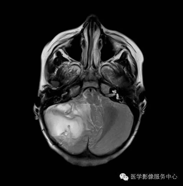 【病例】小脑脓肿1例MR影像表现 【病例】小脑脓肿1例MR影像表现