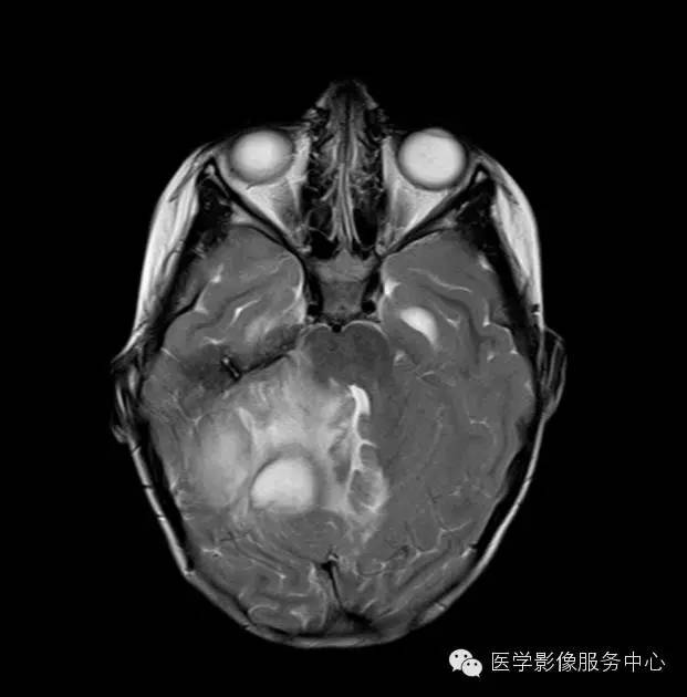【病例】小脑脓肿1例MR影像表现 【病例】小脑脓肿1例MR影像表现