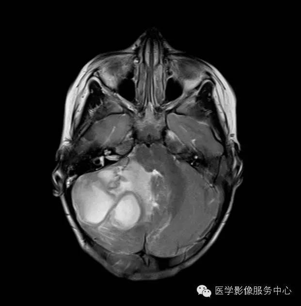 【病例】小脑脓肿1例MR影像表现 【病例】小脑脓肿1例MR影像表现