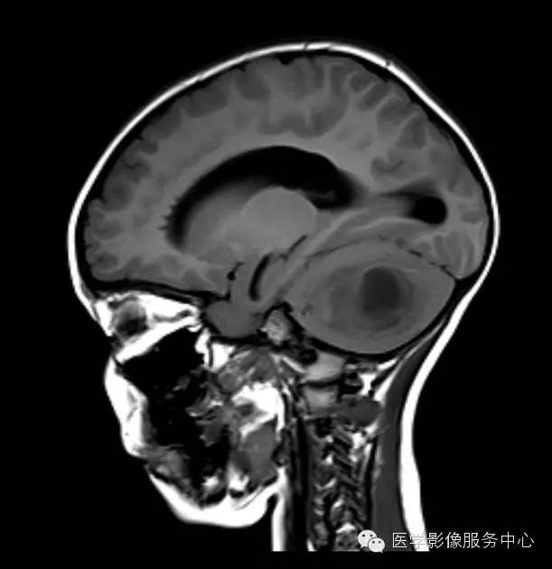 【病例】小脑脓肿1例MR影像表现 【病例】小脑脓肿1例MR影像表现