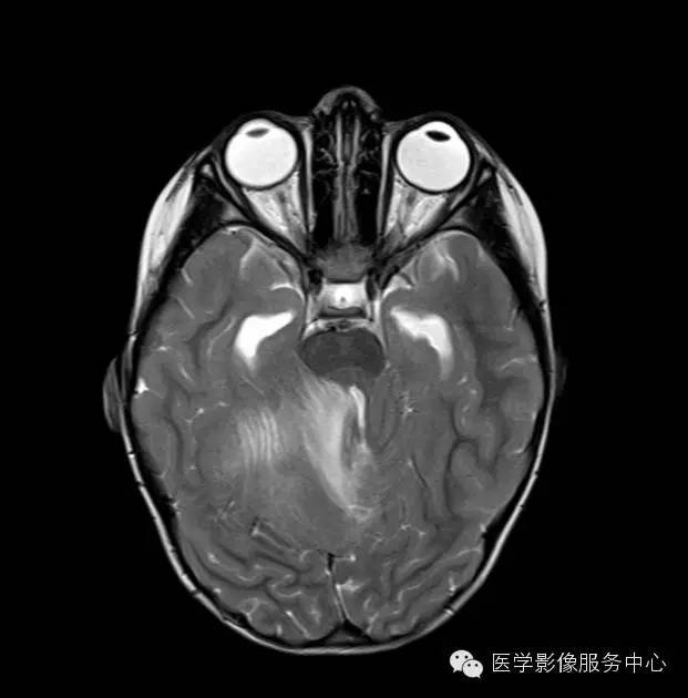 【病例】小脑脓肿1例MR影像表现 【病例】小脑脓肿1例MR影像表现