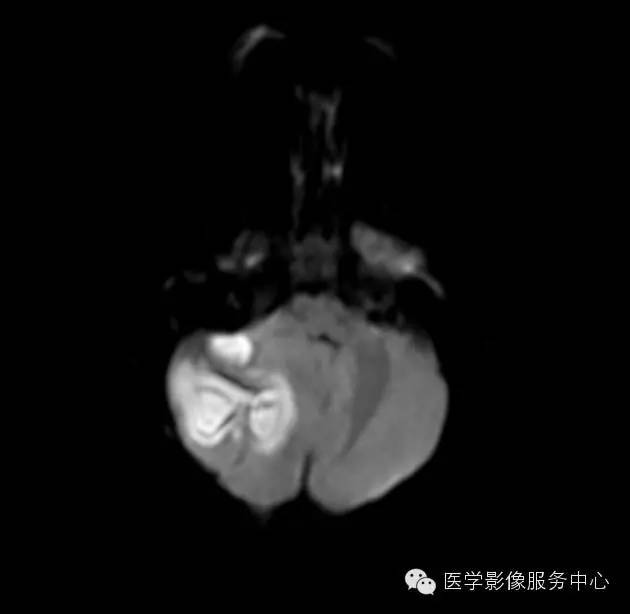 【病例】小脑脓肿1例MR影像表现 【病例】小脑脓肿1例MR影像表现