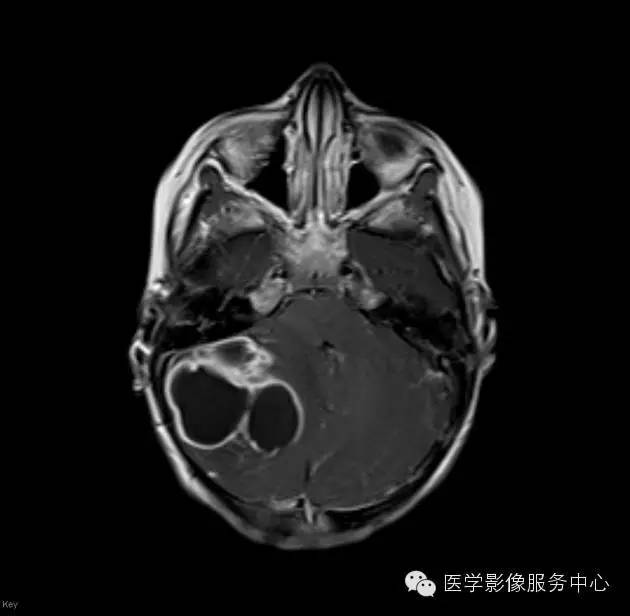 【病例】小脑脓肿1例MR影像表现 【病例】小脑脓肿1例MR影像表现