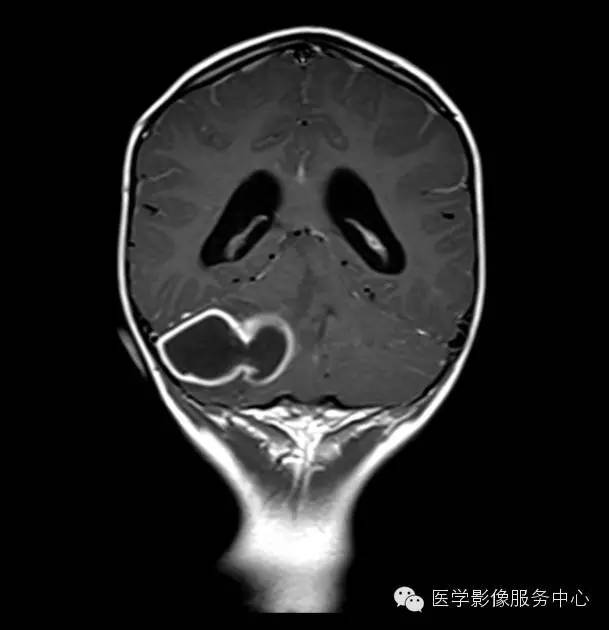 【病例】小脑脓肿1例MR影像表现 【病例】小脑脓肿1例MR影像表现