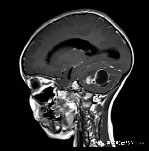 【病例】小脑脓肿1例MR影像表现 【病例】小脑脓肿1例MR影像表现