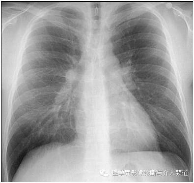 【病例】肺结节病1例X线影像表现