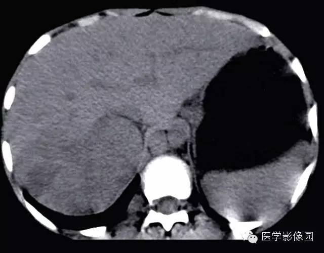 【病例】肾母细胞瘤1例CT影像表现