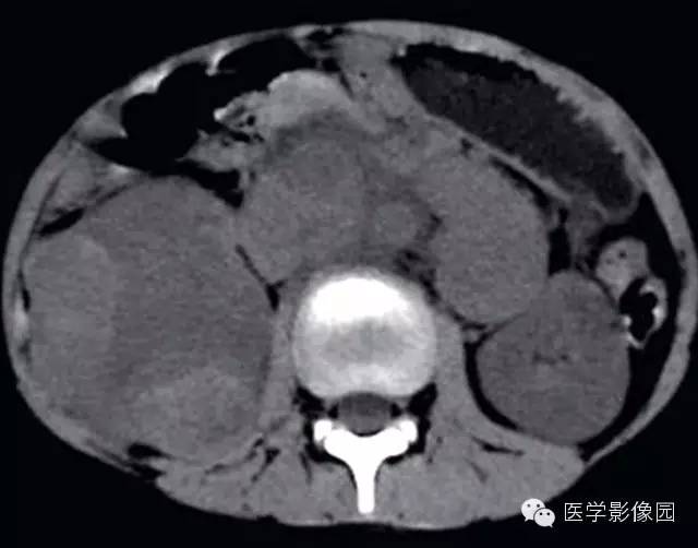 【病例】肾母细胞瘤1例CT影像表现
