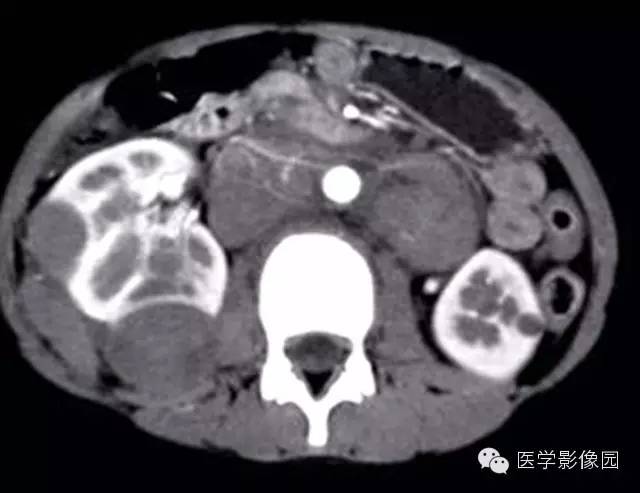 【病例】肾母细胞瘤1例CT影像表现