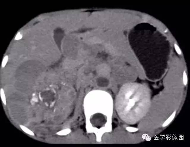 【病例】肾母细胞瘤1例CT影像表现