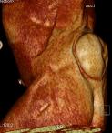 【病例】脊柱裂并脊髓脊膜膨出1里CT影像表现 【病例】脊柱裂并脊髓脊膜膨出1里CT影像表现