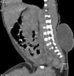 【病例】脊柱裂并脊髓脊膜膨出1里CT影像表现 【病例】脊柱裂并脊髓脊膜膨出1里CT影像表现