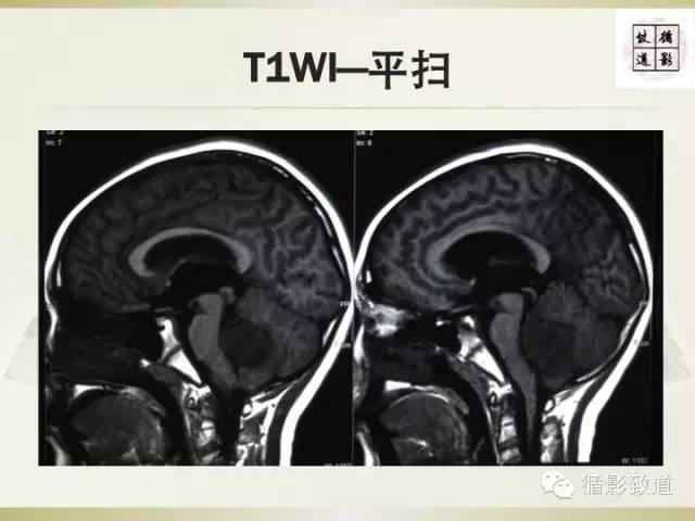 【病例】促纤维增生型髓母细胞瘤1例MR影像表现