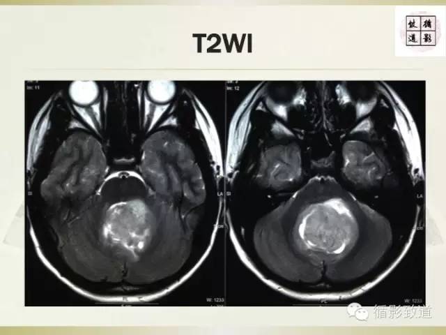 【病例】促纤维增生型髓母细胞瘤1例MR影像表现