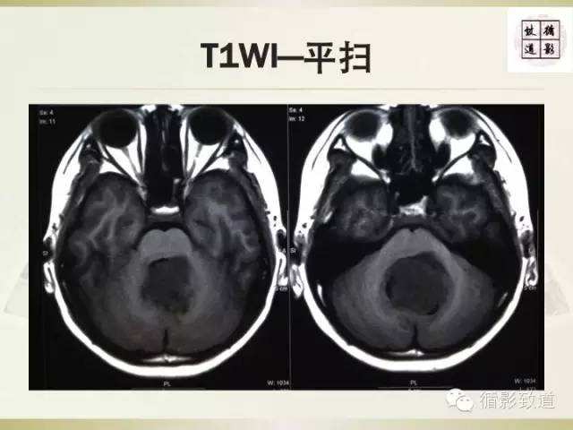 【病例】促纤维增生型髓母细胞瘤1例MR影像表现
