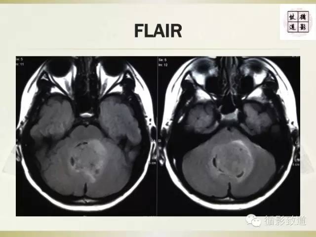 【病例】促纤维增生型髓母细胞瘤1例MR影像表现