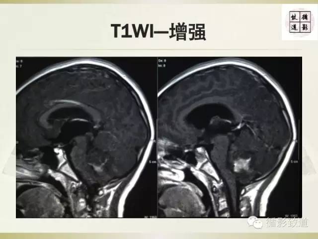 【病例】促纤维增生型髓母细胞瘤1例MR影像表现
