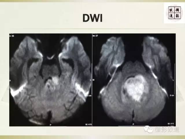 【病例】促纤维增生型髓母细胞瘤1例MR影像表现