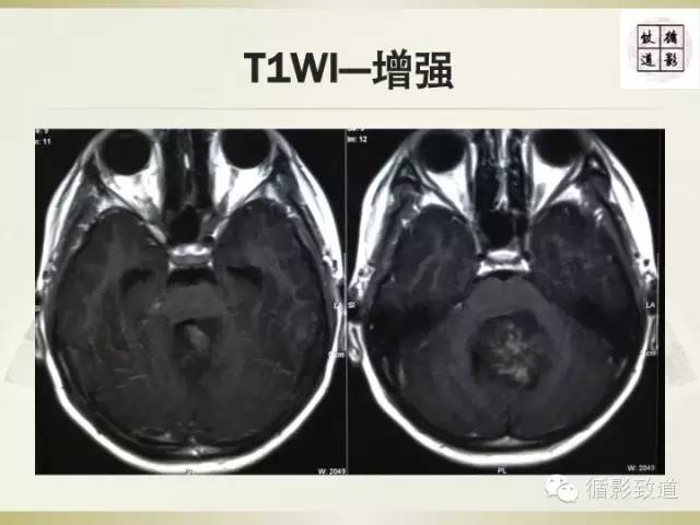 【病例】促纤维增生型髓母细胞瘤1例MR影像表现