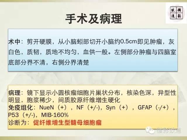 【病例】促纤维增生型髓母细胞瘤1例MR影像表现