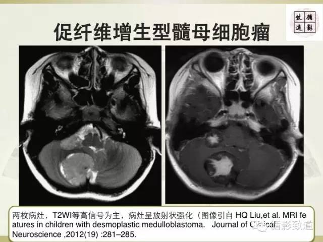 【病例】促纤维增生型髓母细胞瘤1例MR影像表现