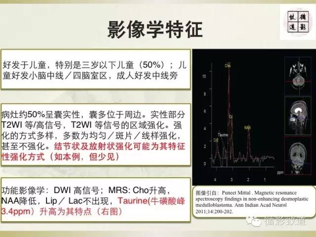 【病例】促纤维增生型髓母细胞瘤1例MR影像表现