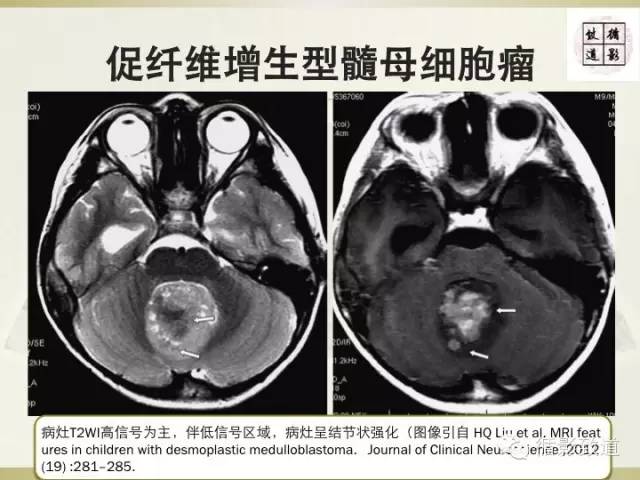 【病例】促纤维增生型髓母细胞瘤1例MR影像表现