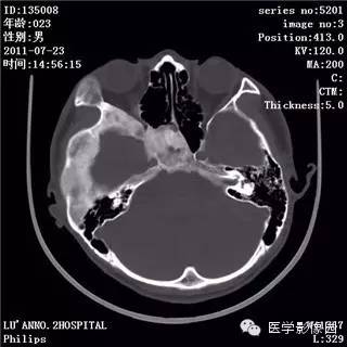 【病例】颅骨骨纤维异常增殖症1例CT影像表现