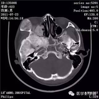 【病例】颅骨骨纤维异常增殖症1例CT影像表现 【病例】颅骨骨纤维异常增殖症1例CT影像表现