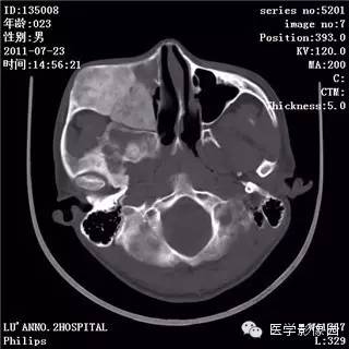 【病例】颅骨骨纤维异常增殖症1例CT影像表现 【病例】颅骨骨纤维异常增殖症1例CT影像表现