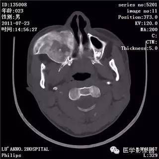 【病例】颅骨骨纤维异常增殖症1例CT影像表现 【病例】颅骨骨纤维异常增殖症1例CT影像表现