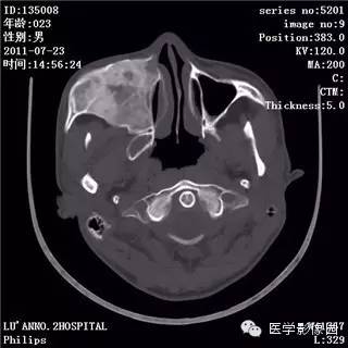 【病例】颅骨骨纤维异常增殖症1例CT影像表现 【病例】颅骨骨纤维异常增殖症1例CT影像表现