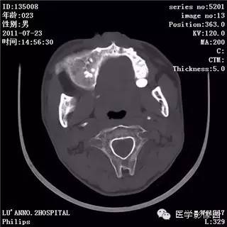 【病例】颅骨骨纤维异常增殖症1例CT影像表现 【病例】颅骨骨纤维异常增殖症1例CT影像表现