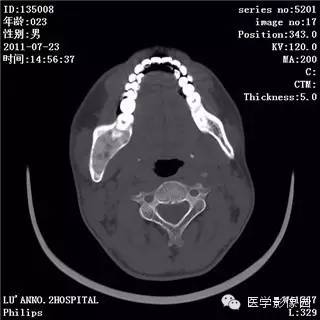【病例】颅骨骨纤维异常增殖症1例CT影像表现 【病例】颅骨骨纤维异常增殖症1例CT影像表现